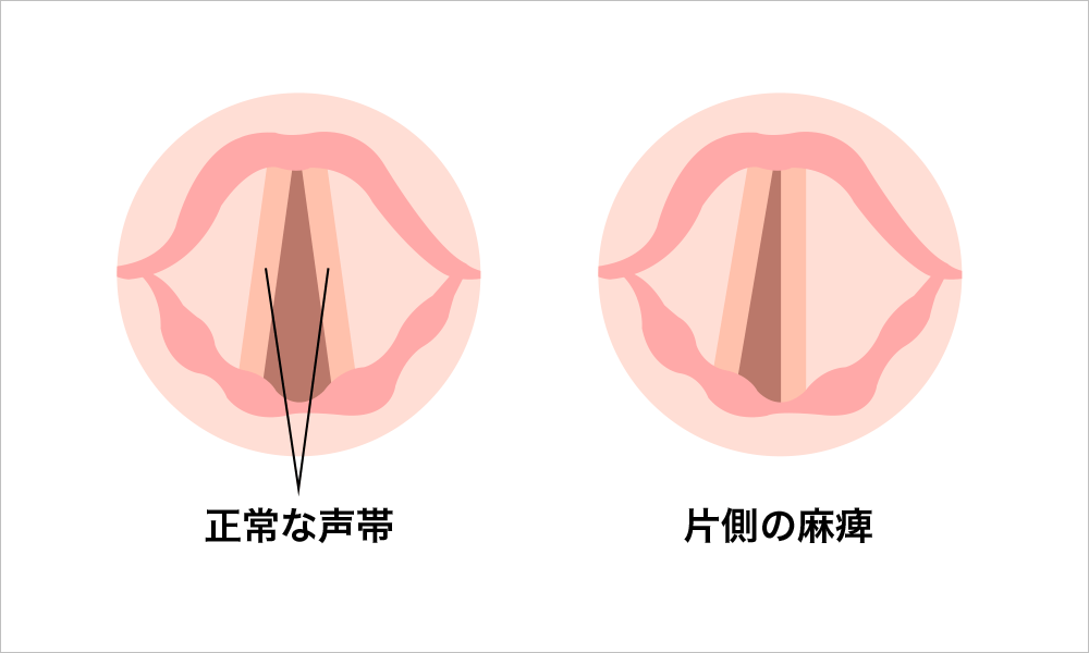 正常な声帯と片側の麻痺