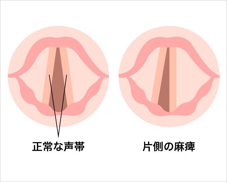 正常な声帯と片側の麻痺