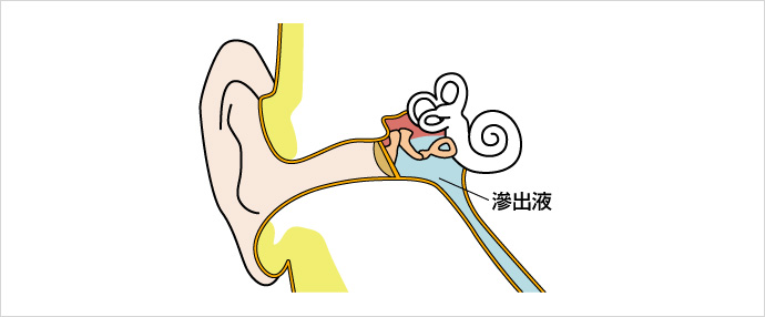 滲出性中耳炎