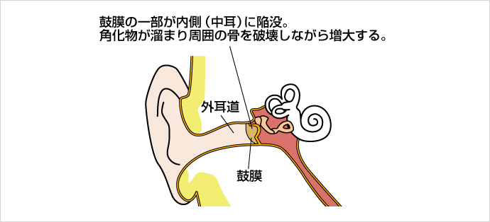 真珠腫性中耳炎