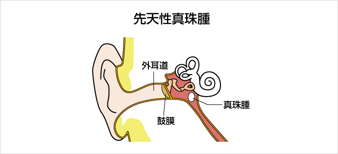 先天性真珠腫