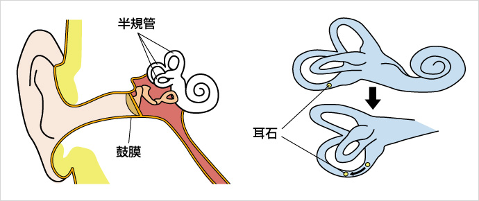 良性発作性頭位めまい症