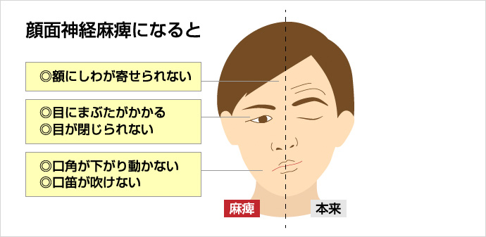 顔面神経麻痺