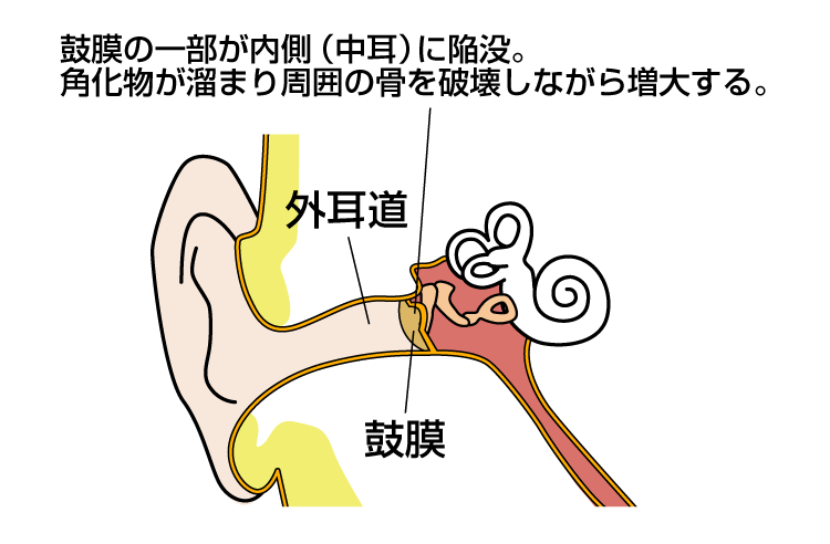 滲出性中耳炎