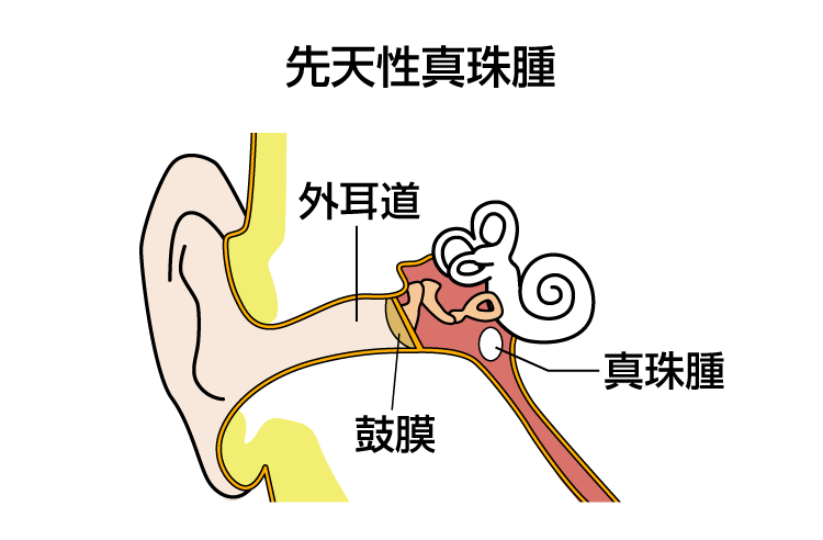 先天性真珠腫