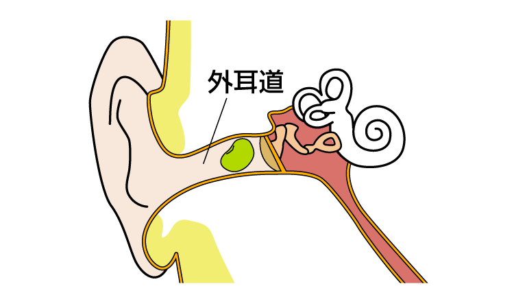 外耳道異物