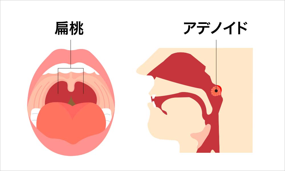 （口蓋）扁桃とアデノイド