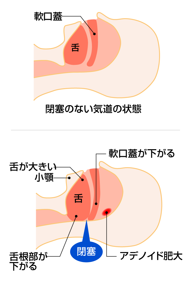 睡眠時無呼吸の原因