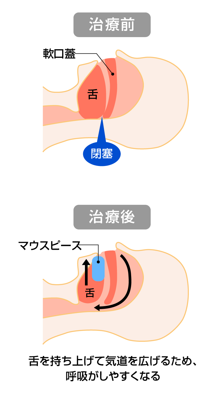 マウスピースによる治療