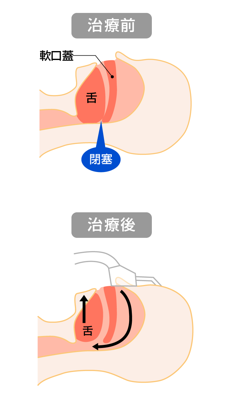 睡眠時無呼吸の原因