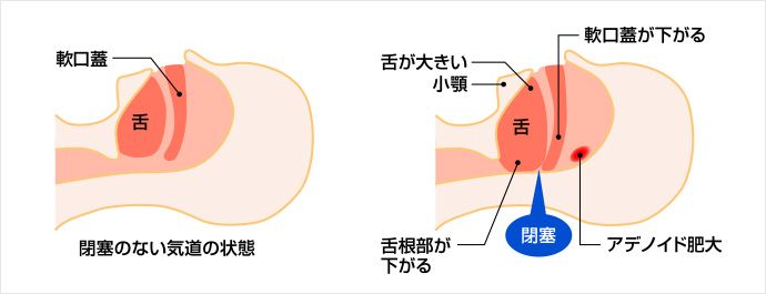 睡眠時無呼吸の原因