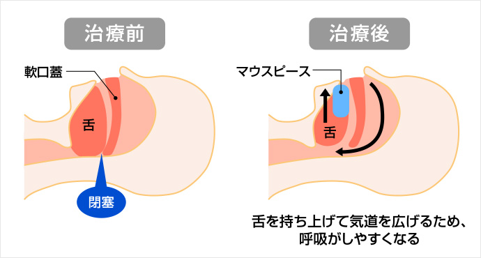 マウスピースによる治療