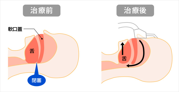 ＣＰＡＰ（経鼻的持続陽圧呼吸療法）による治療